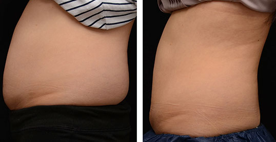 CoolSculpting Results