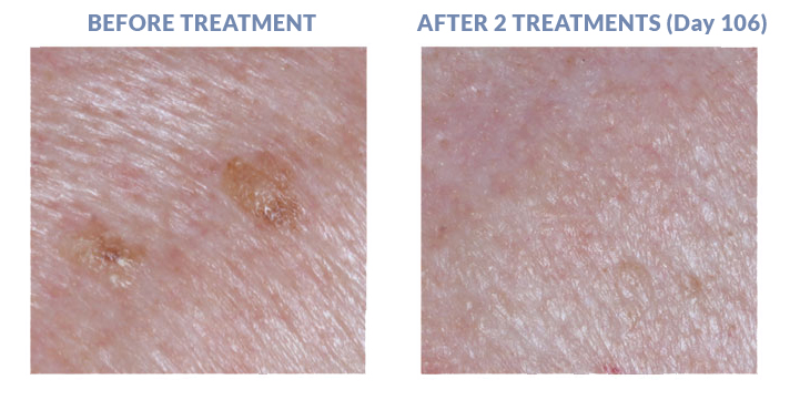 Seborrheic Keratoses - Results 3