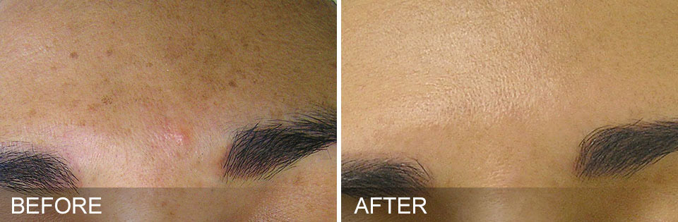 Hydrafacial - Before & after Brown Spots
