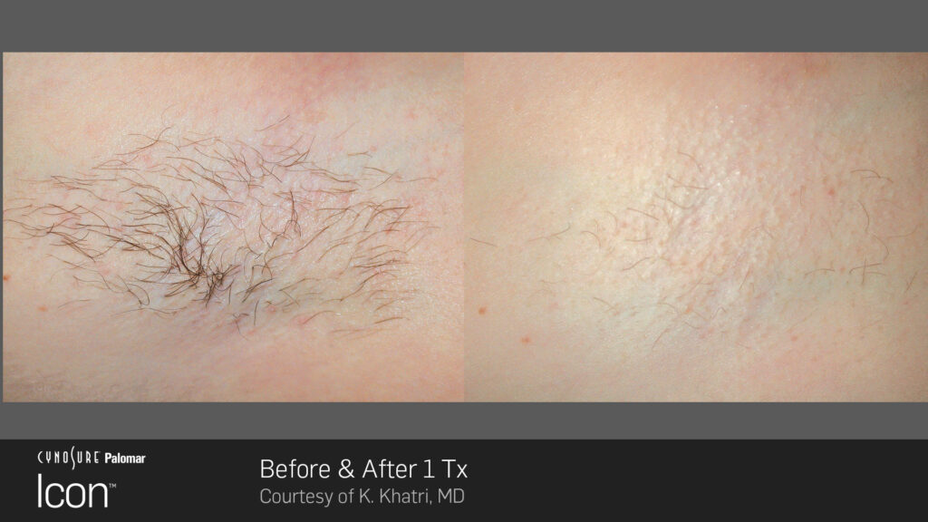 Laser Hair Removal - Before and After one treatment