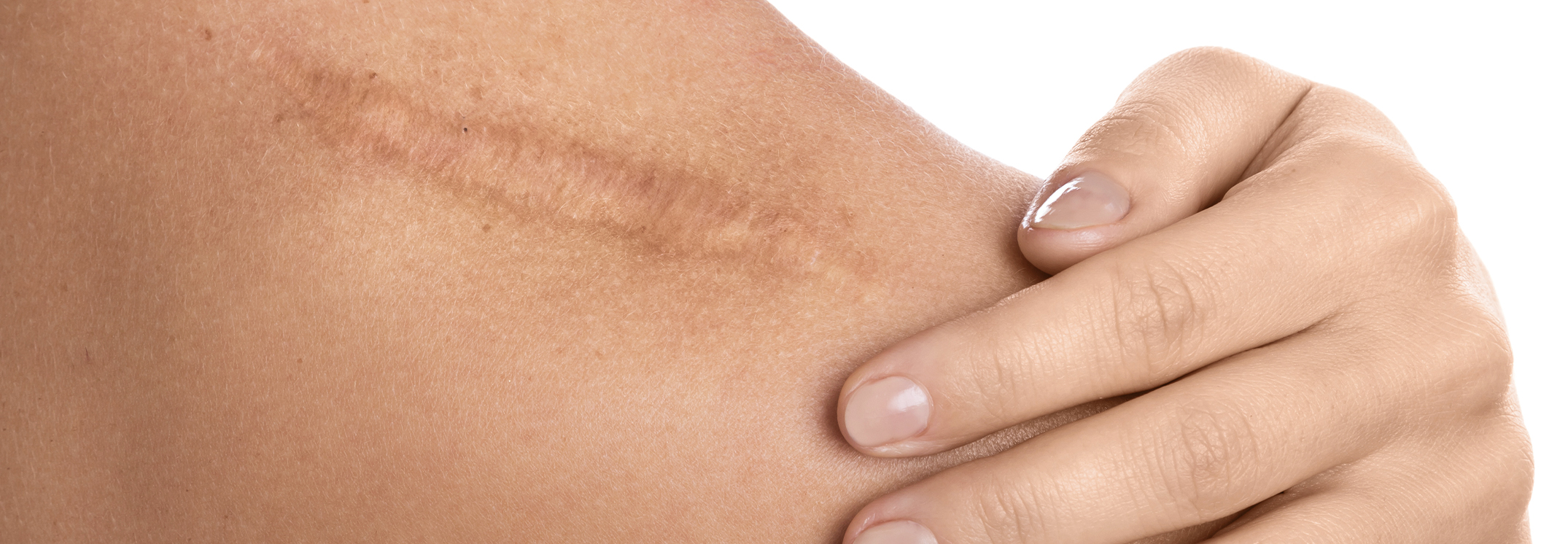 scar blog image