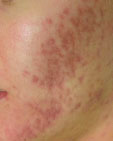 SkinPen-img02
